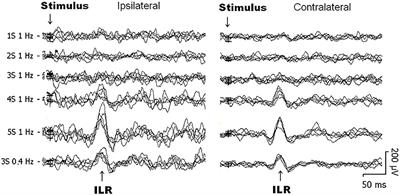 Habituation of the Interlimb Reflex (ILR) Over the Biceps Brachii Muscle After Electrical Stimuli Over the Sural Nerve